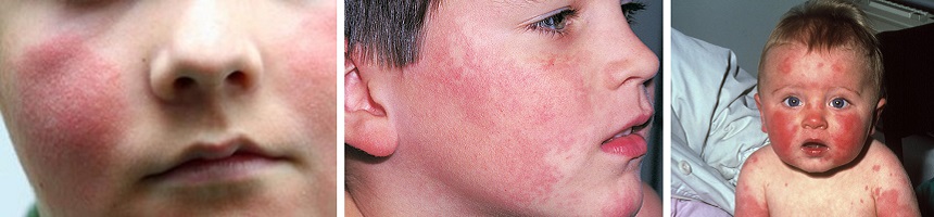 Инфекционная эритема у детей на лице