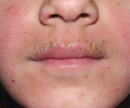 Аллергический контактный дерматит вокруг рта