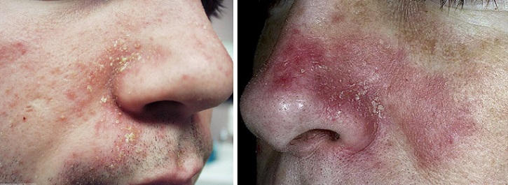 Себорейный дерматит вокруг носа