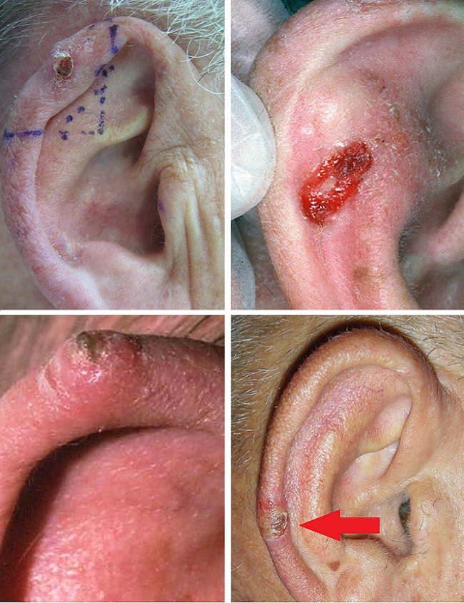 Рак кожи уха