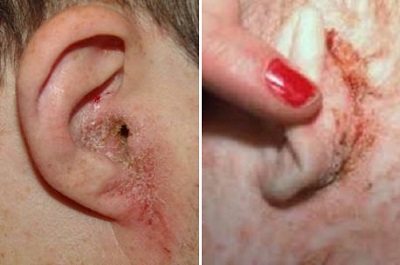 Себорейный дерматит ушей