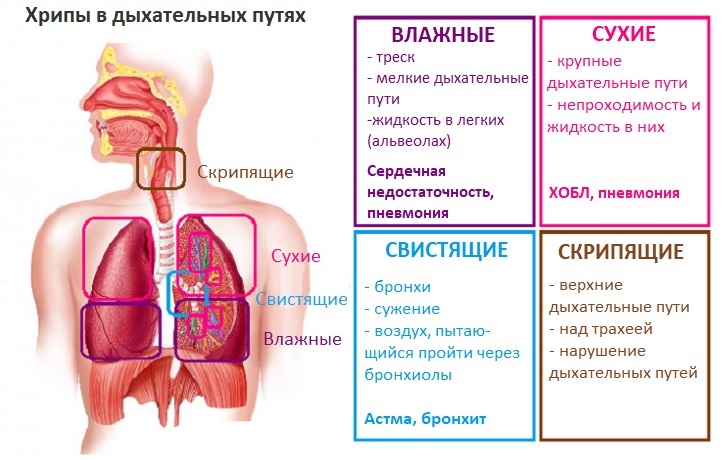 Свистящие хрипы — причины, обследование и лечение в Астрахани | Симптомы | Клиника «Консилиум»