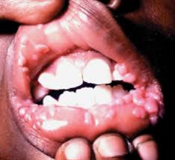 Тяжелая бактериальная инфекция во рту