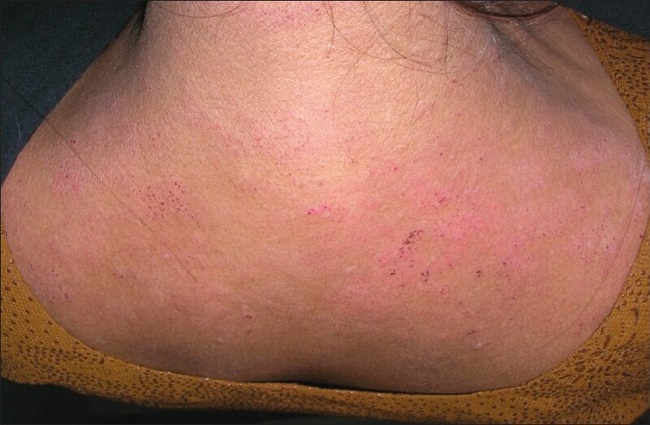 Контактный дерматит на шее и плечах