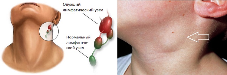 Опухший лимфатический узел на шее